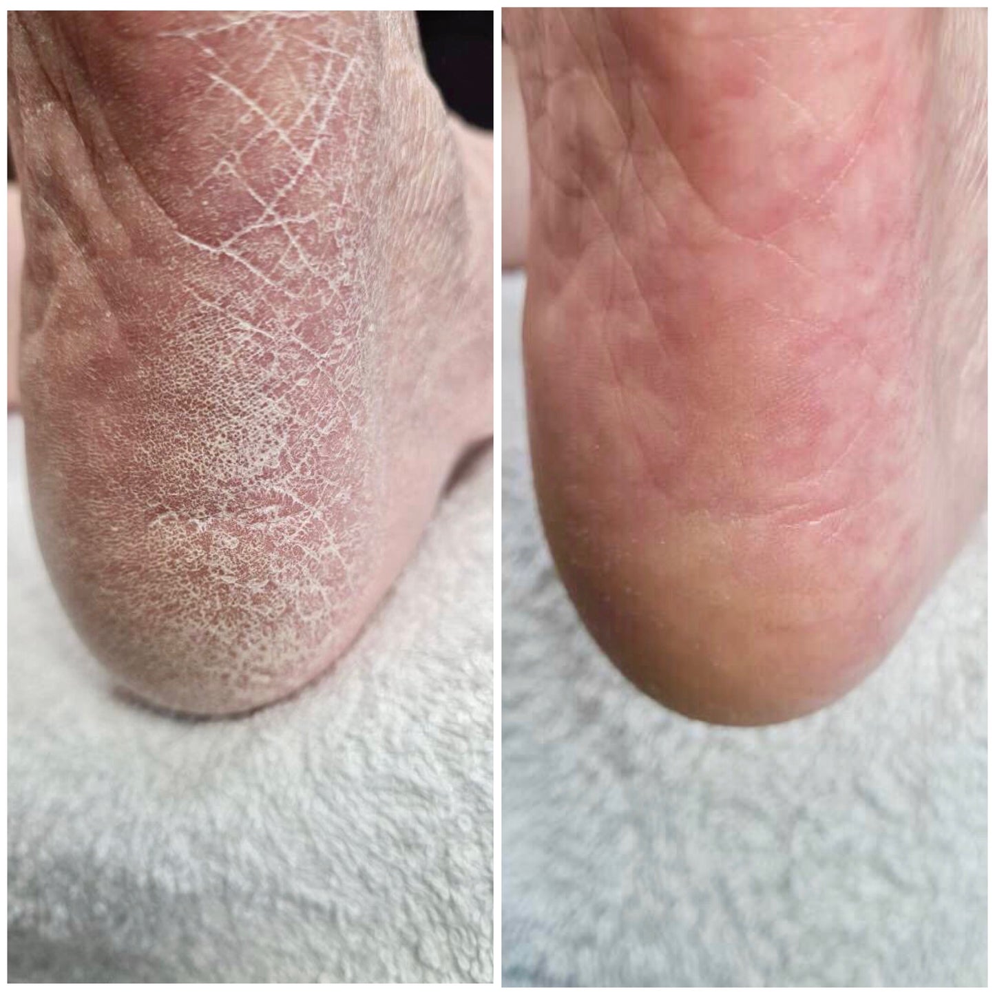 LOVASKIN INSTANT FOOT PEEL Travel Bottle - Over 10 Beauty pedicure treatments